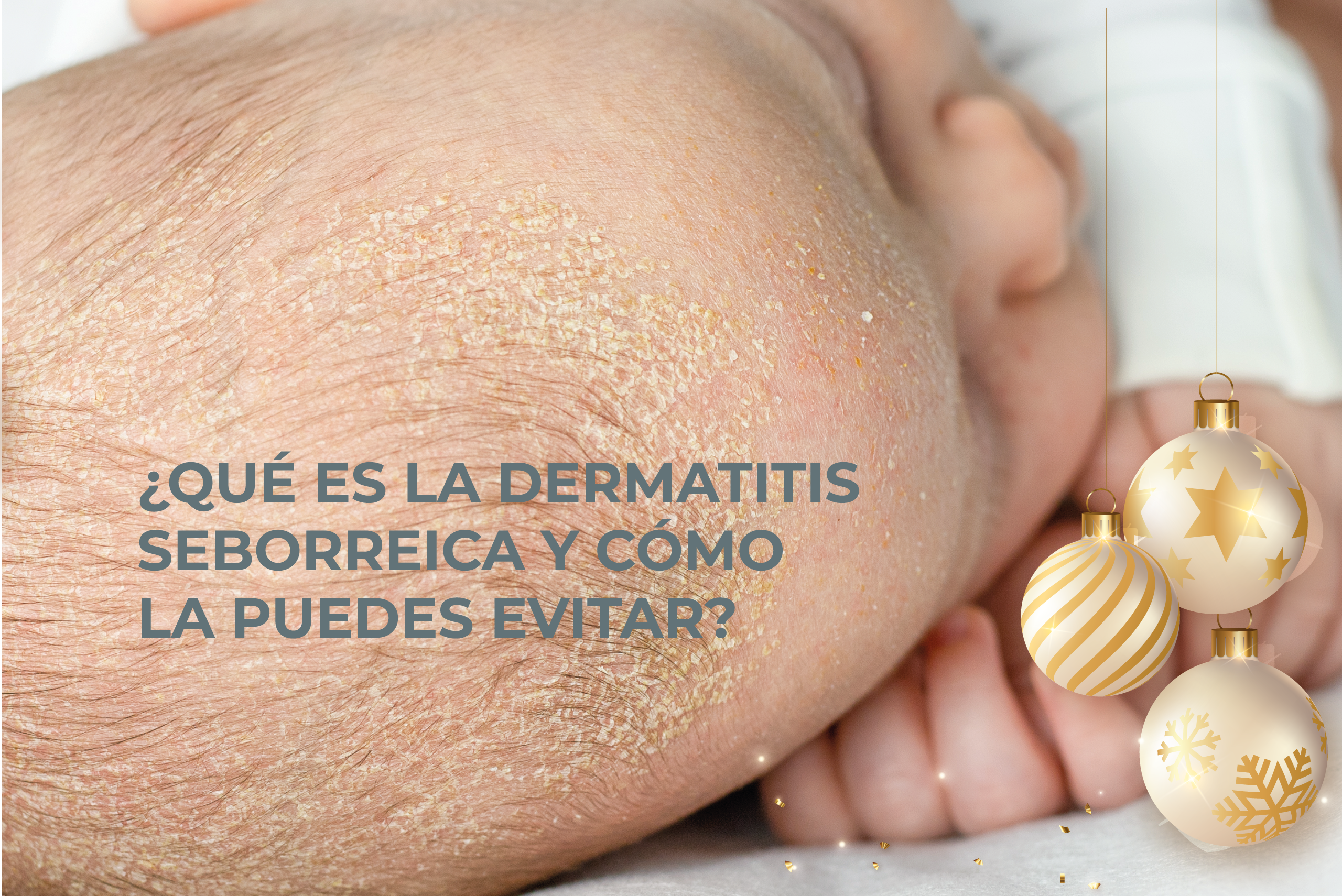 Dermatitis seborreica