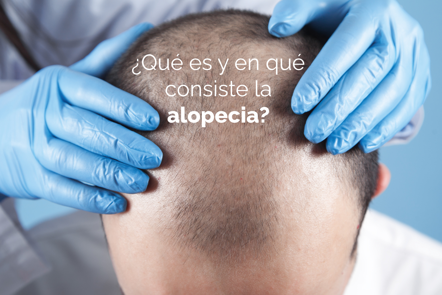 Tipos de alopecia y tratamientos
