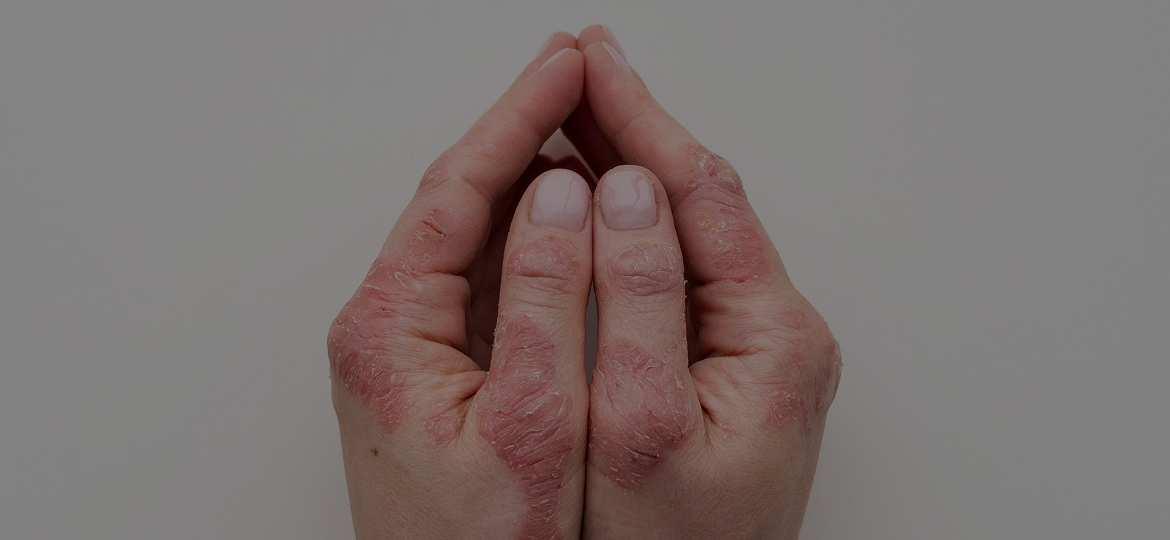 Qué es la psoriasis y cuál es el tratamiento indicado