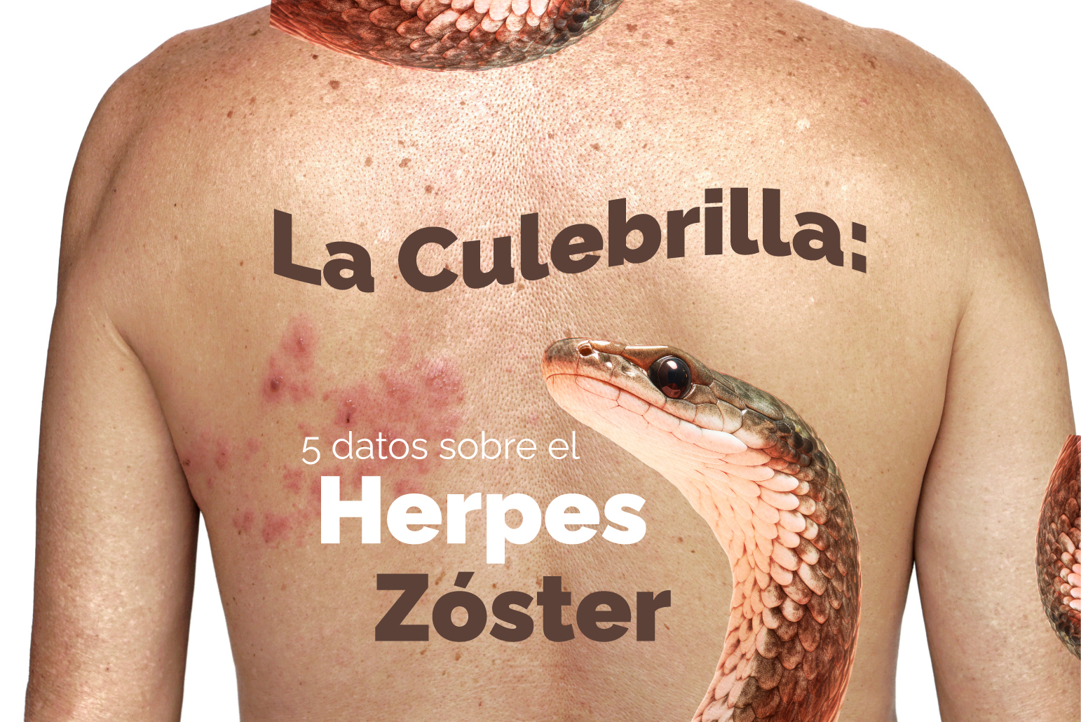 Culebrilla Herpes Zoster