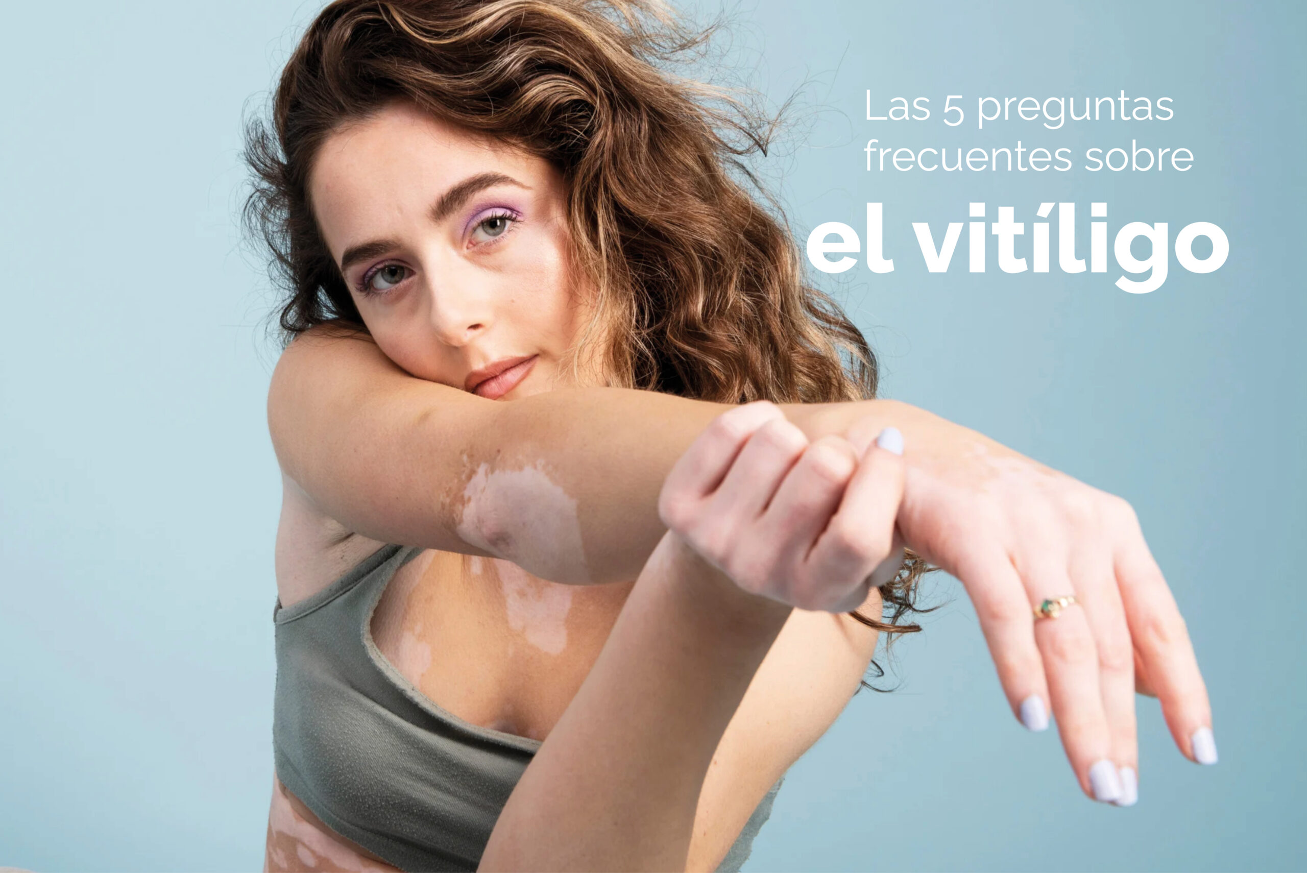5 preguntas frecuentes sobre el vitíligo
