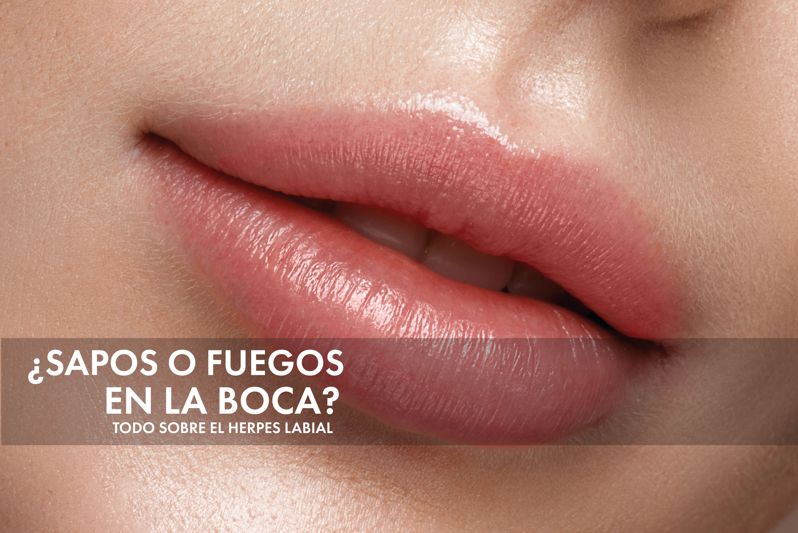 Herpes Labial- Sapos o fuegos en la boca