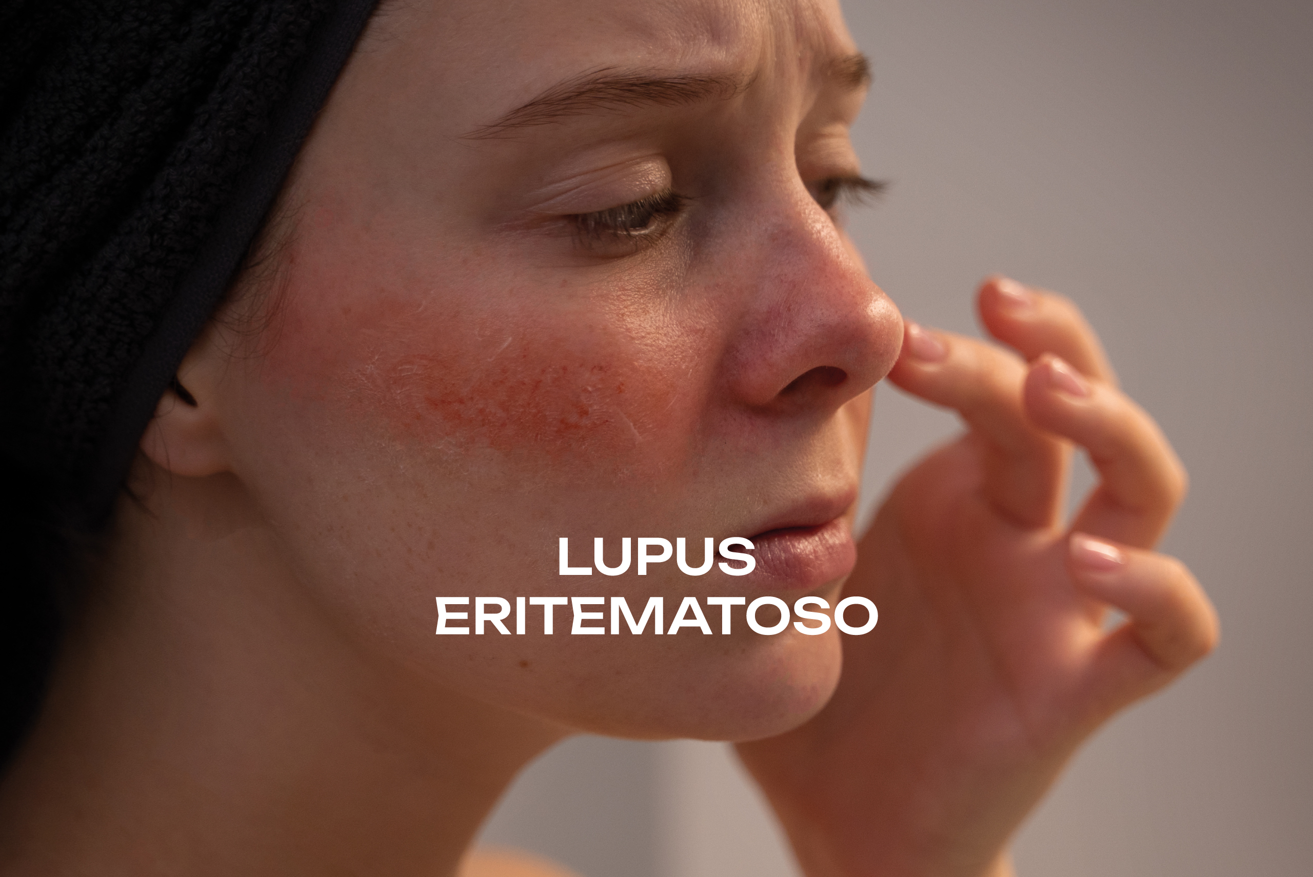 Lupus eritematoso